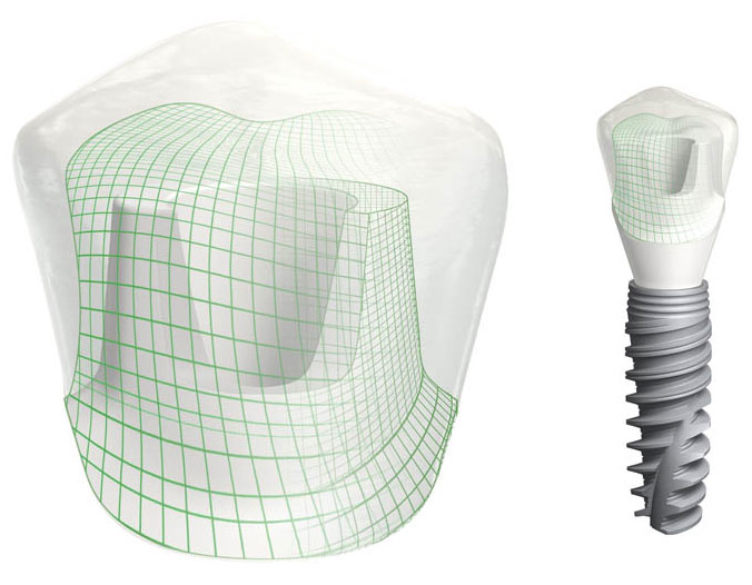 image-schema-implant-clinique-cpwi